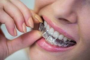 Unmasking 5 Misconceptions About Invisalign The Colony TX
